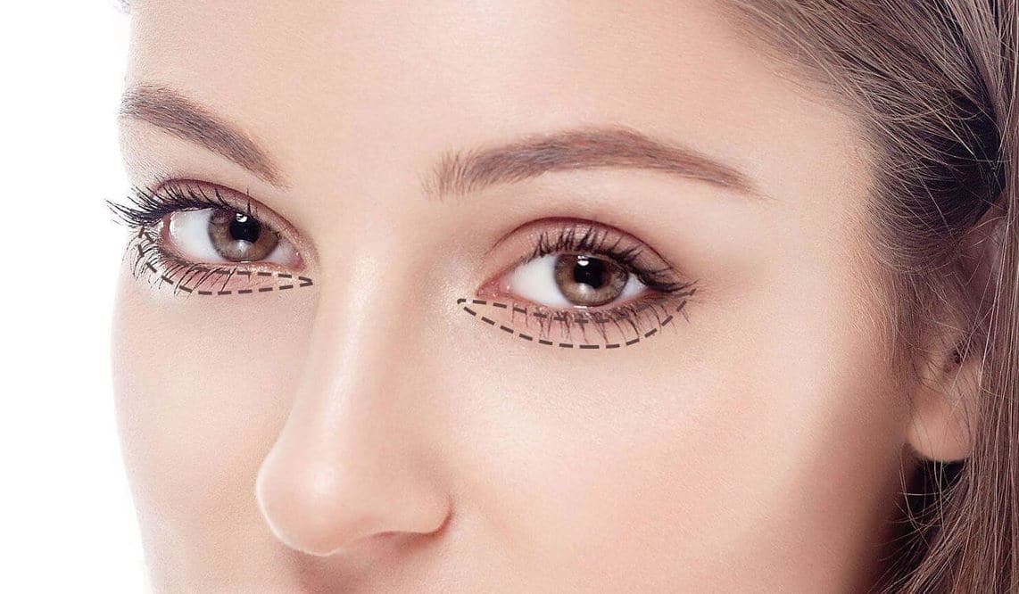 Blepharoplastie Tunisie - Chirurgie esthétique des paupières