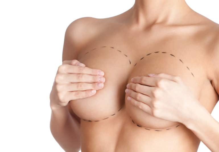 Augmentation mammaire par protheses - Lipofilling mammaire