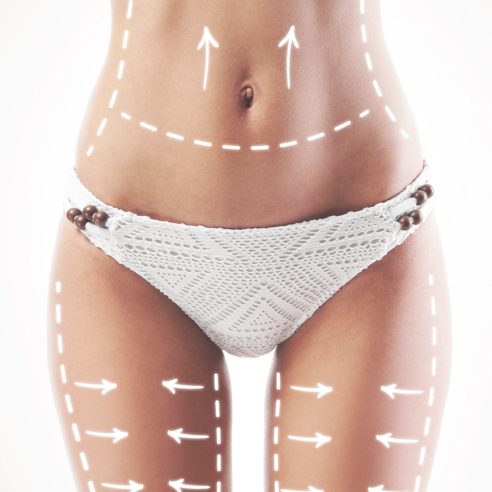 Chirurgie de la silhouette - Abdominoplastie