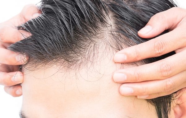 Greffe de cheveux Tunisie - Chirurgie Homme Tunisie