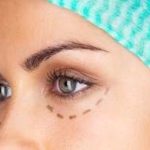 Blépharoplastie Tunisie - Chirurgie Visage Tunisie