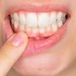 Chirurgie dentaire Tunisie - Gingivectomie