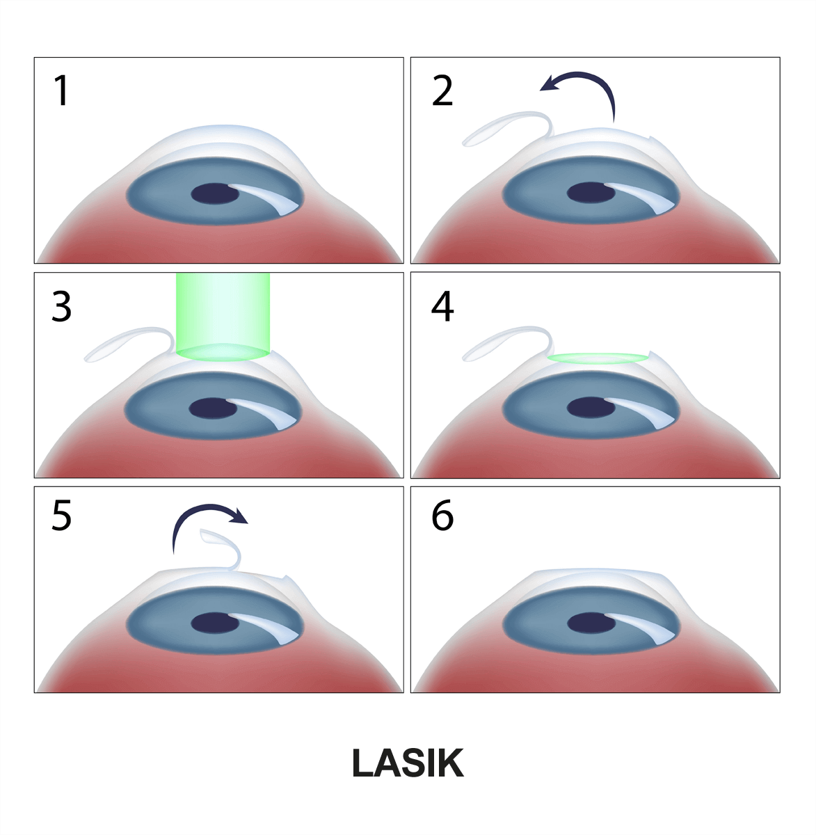 Opération laser yeux Tunisie - Lasik Tunisie