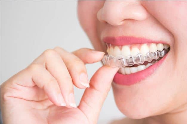 Blanchiment des dents par gouttière individualisée