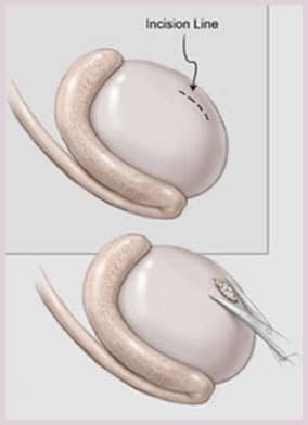 biopsie testiculaire - traitement de l'infertilité
