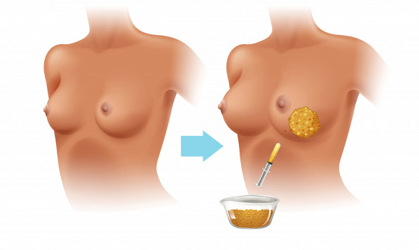Lipofilling seins Tunisie - Lipofilling mammaire Tunisie