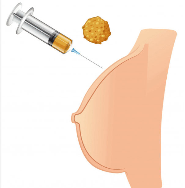 lipofilling sein Tunisie - chirurgie mammaire