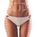 Cryolipolyse Tunisie - Coolsculpting
