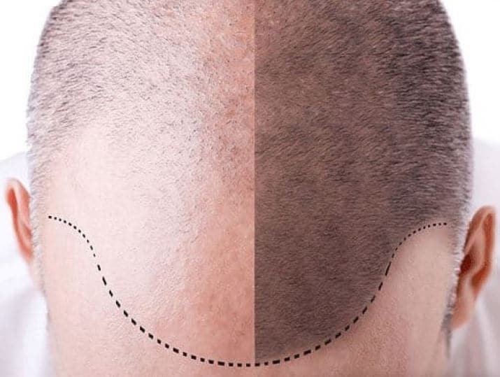 Greffe de Cheveux Tunisie - Implant capillaire FUE