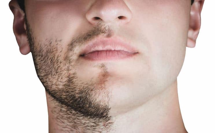 Greffe de barbe Tunisie - Implant barbe