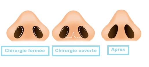 Types de rhinoplastie Tunisie