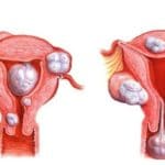 Myomectomie en Tunisie - Ablation des fibromes