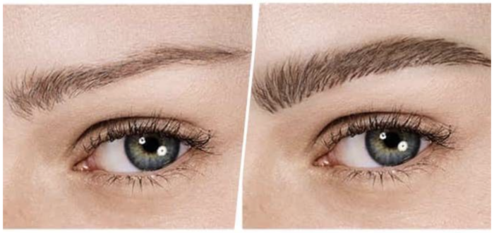 Greffe des sourcils en Tunisie