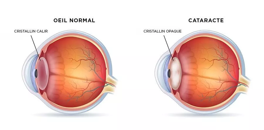 Opération cataracte Tunisie - Implant cataracte