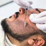 Greffe de barbe Tunisie- Chirurgie Homme Tunisie