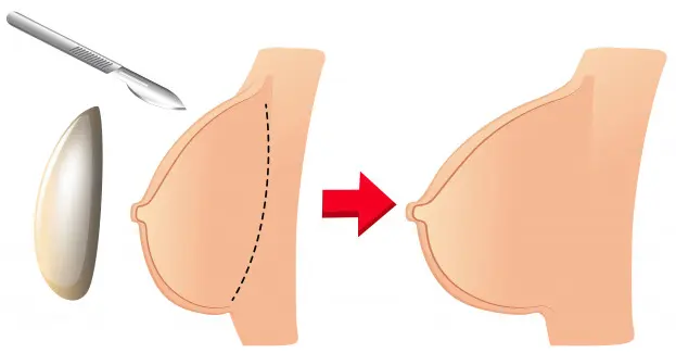 Pose prothese mammaire - Augmentation Mammaire Tunisie