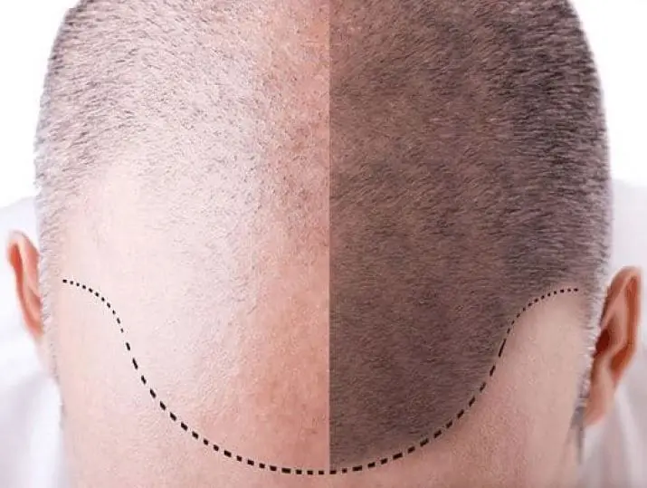 Greffe de cheveux Tunisie - Implant capillaire FUE