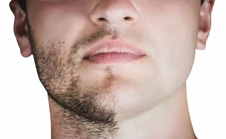 Greffe de barbe Tunisie- Chirurgie Homme Tunisie