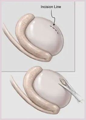 biopsie testiculaire - traitement de l'infertilité