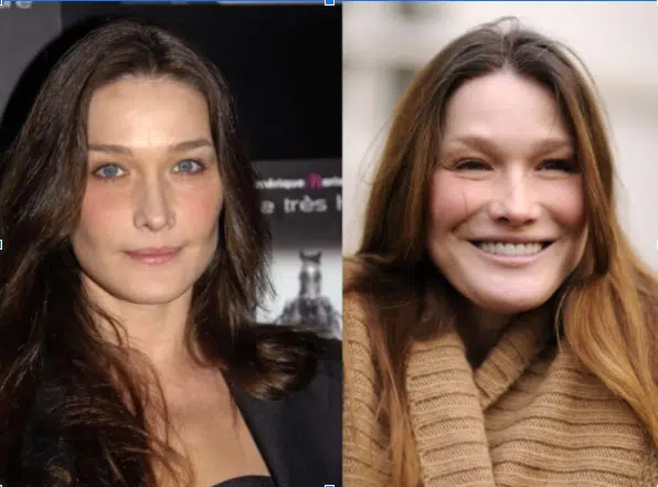 Carla Bruni avant après chirurgie esthétique