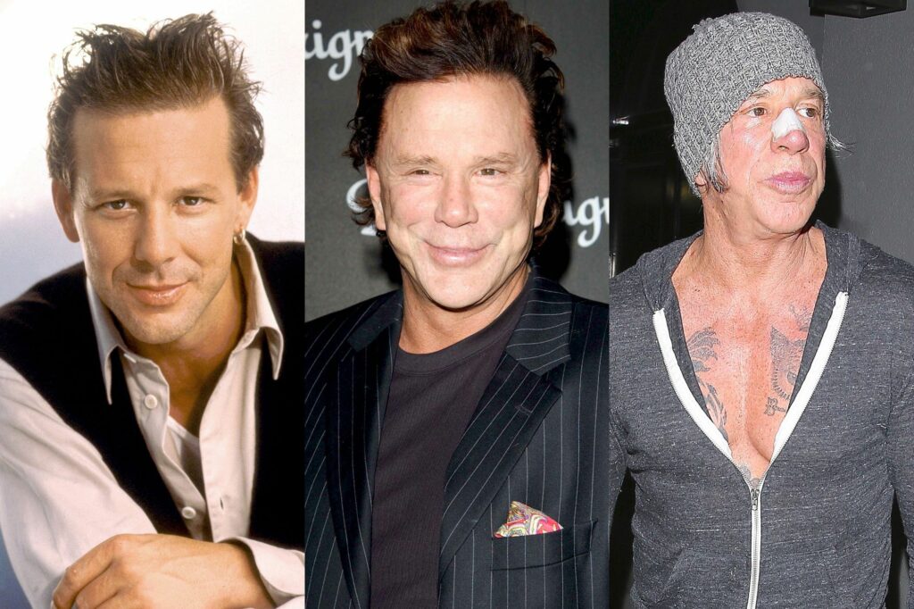 Chirurgie esthétique Mickey Rourke