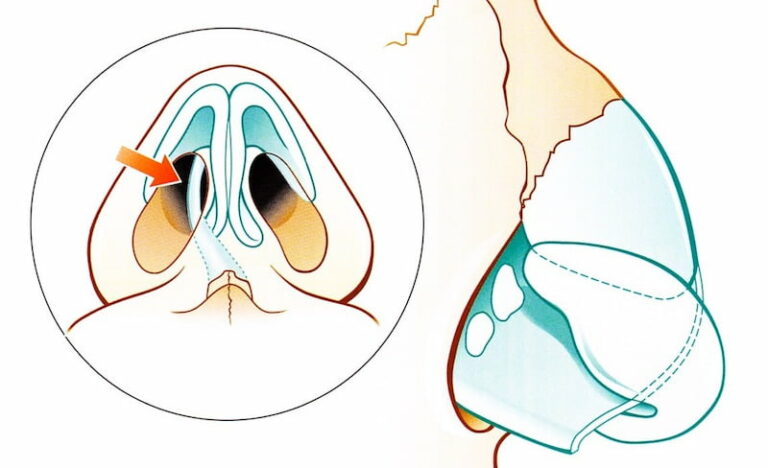 Cloison nasale déviée