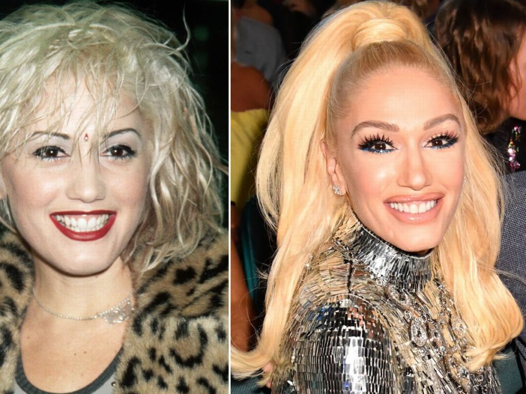 Gwen Stefani Avant/après chirurgie esthétique