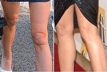 Liposuccion des jambes de Demi Moore