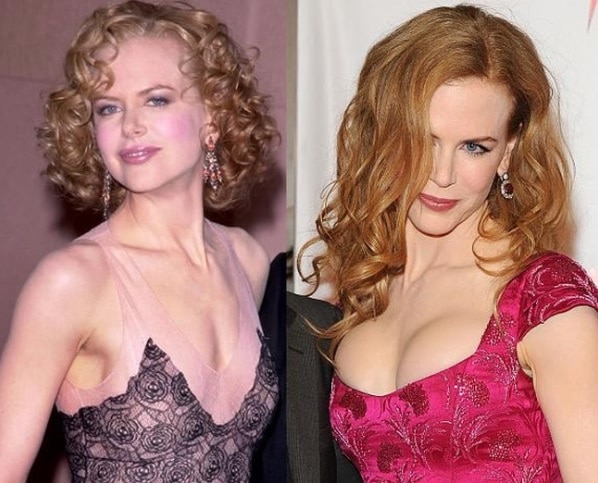 Nicole Kidman Augmentation mammaire