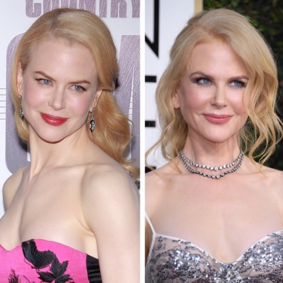 Nicole Kidman Cchirurgie esthétique