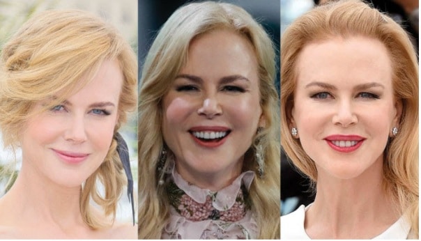Nicole Kidman Injections de Botox
