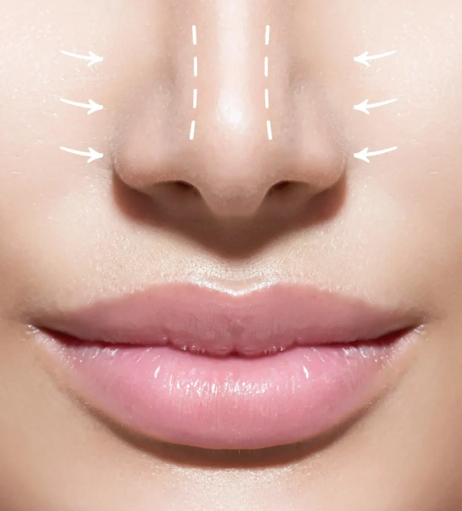 Rhinoplastie Tunisie - Chirurgie Visage Tunisie