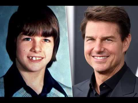 Tom Cruise avant/après chirurgie esthétique