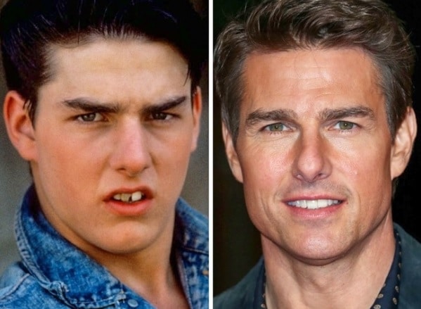 Tom Cruise chirurgie esthétique des dents