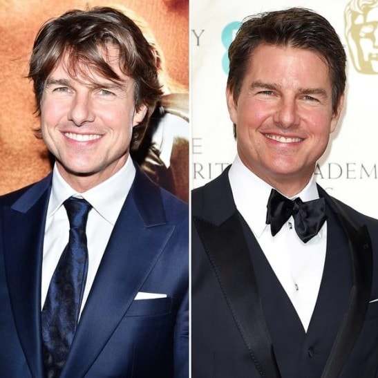 Tom Cruise chirurgie esthétique