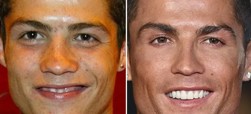 Transformation du nez de Cristiano Ronaldo