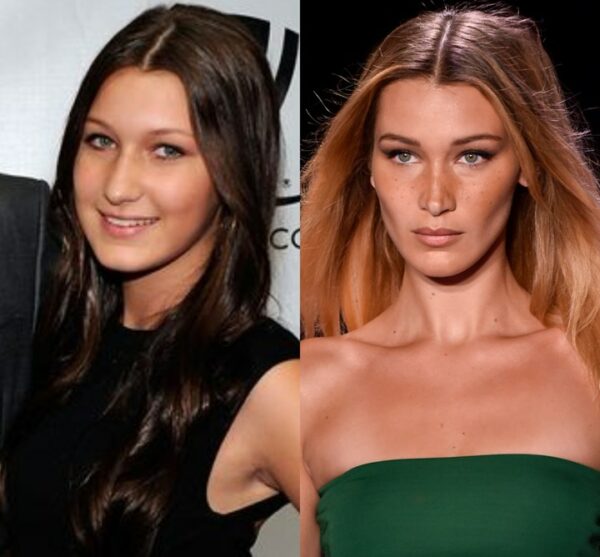 Les chirurgies esthétiques de Bella Hadid Avant/après