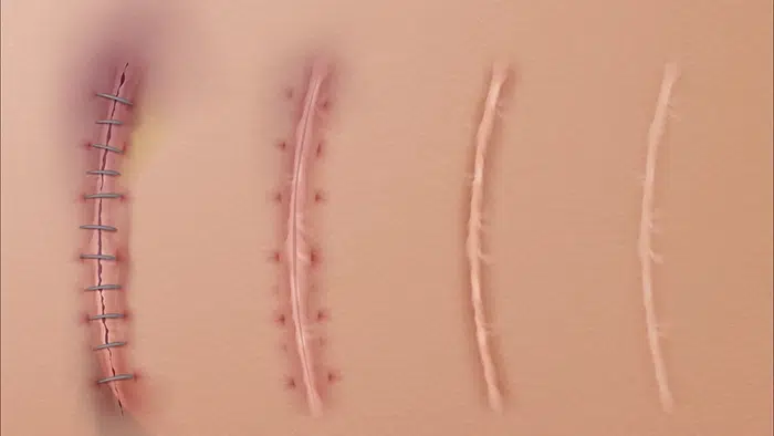 Cicatrice après abdominoplastie
