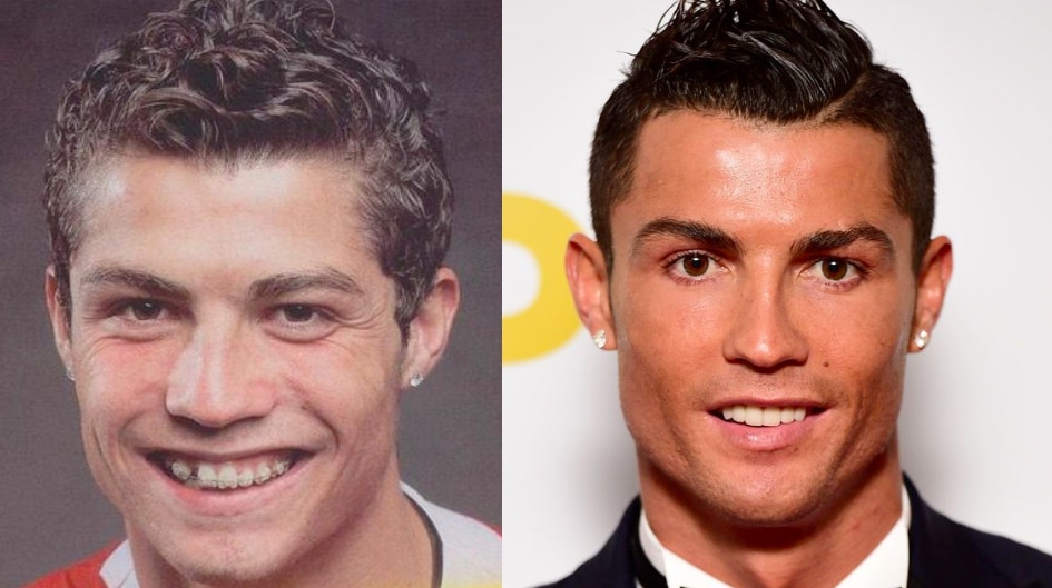 Cristiano Ronaldo Chirurgie esthétique Avant/Après