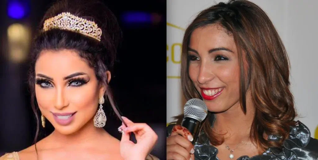 Dounia Batma chirurgie esthétique