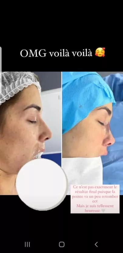 Isabeau Delatour : Elle partage enfin le résultat de son opération du nez