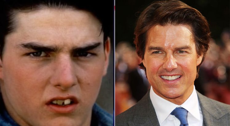 Tom Cruise facettes dentaires Avant/après