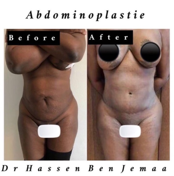 Abdominoplastie Tunisie avant/après