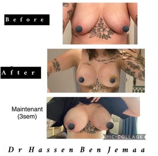 Avant/après Augmentation mammaire