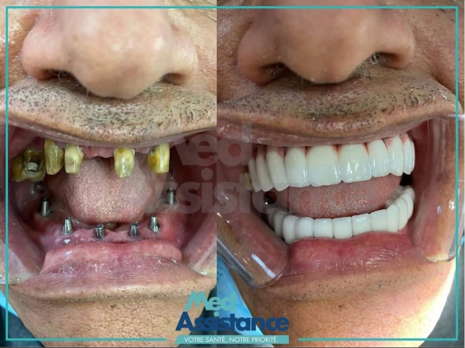 Implant dentaire Tunisie : photo avant/après
