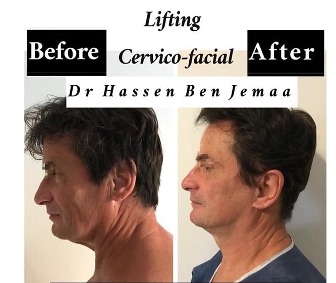 Avant Après Lifting Cervico-facial Tunisie - Dr HBJ
