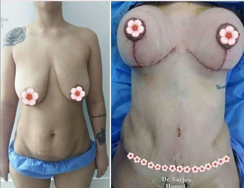 Photos avant/après lifting mammaire Tunisie