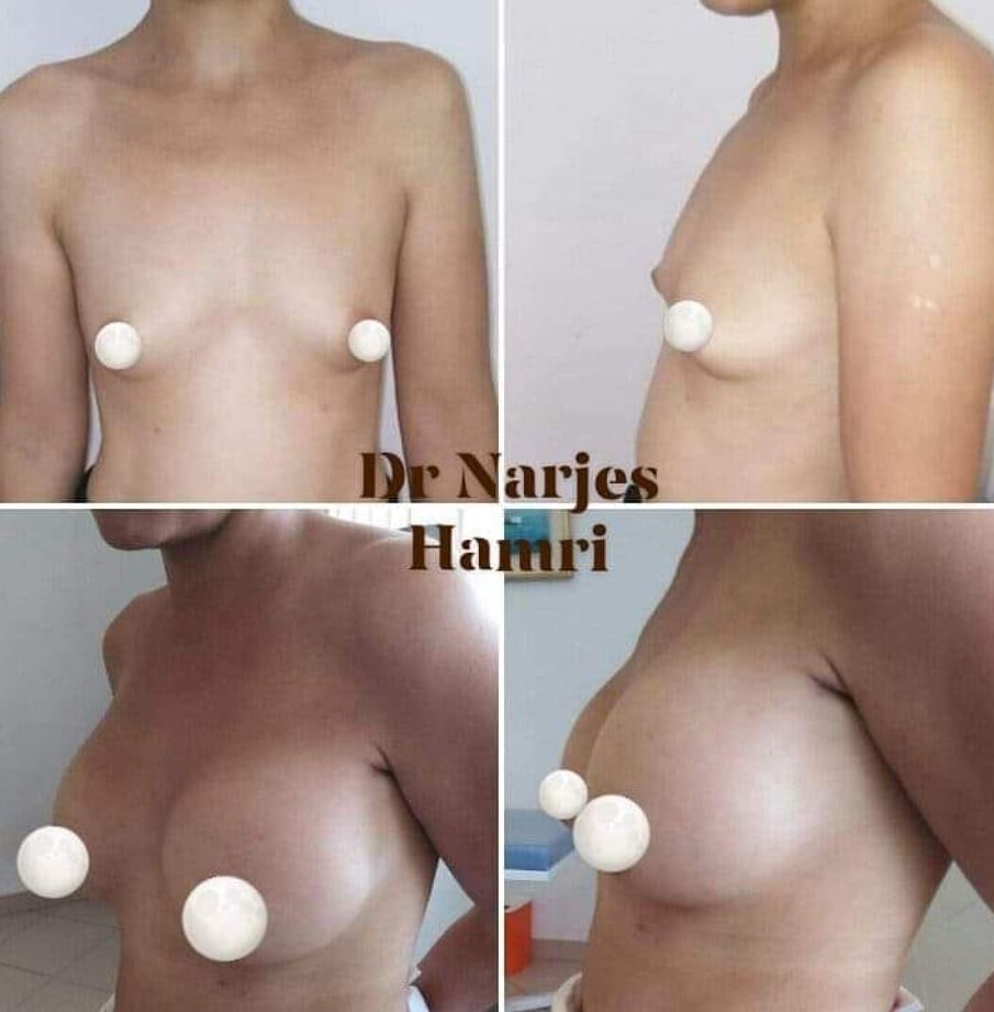 Photos avant/après d'augmentation des seins sous muscles Tunisie