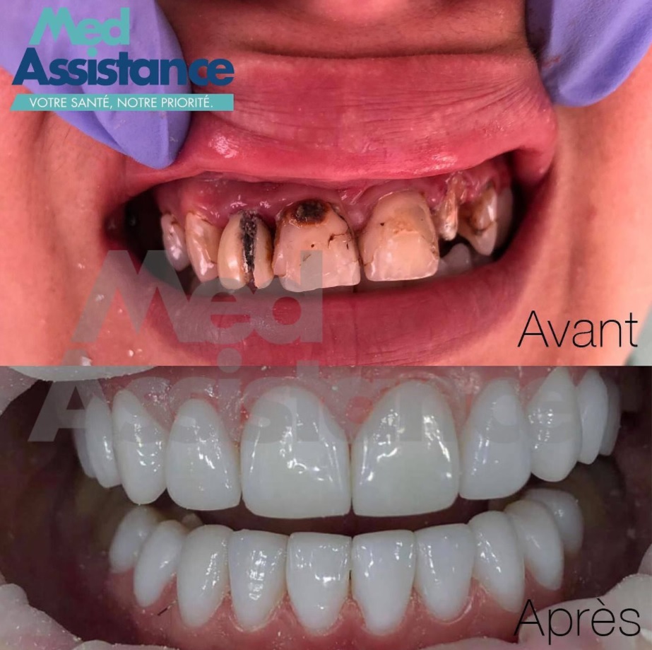 Photo avant/après : Facette dentaire Tunisie