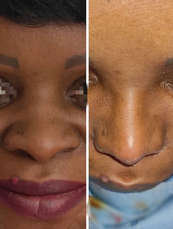 Rhinoplastie ethnique Tunisie avant/après